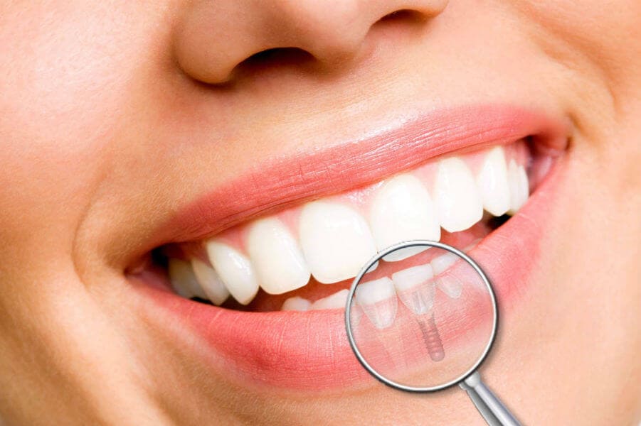 1549266286_Имплантация зуба в стоматологической клинике Фортуна - Киев